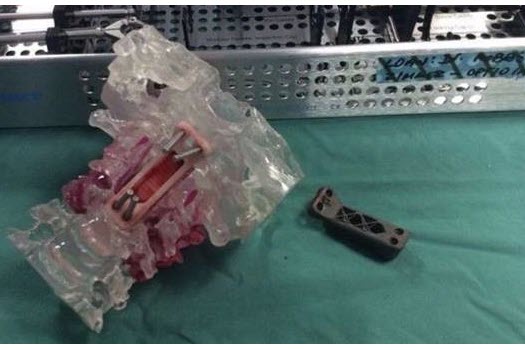 3D Printed Vertebrae A First in Surgery